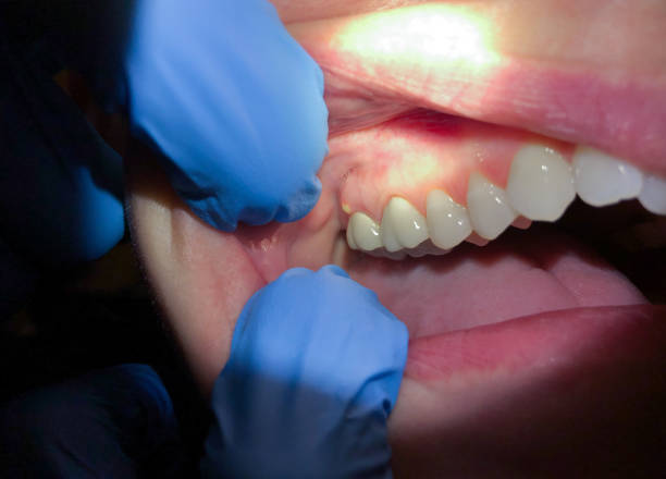 Best Emergency Tooth Extraction  in Pass Christian, MS