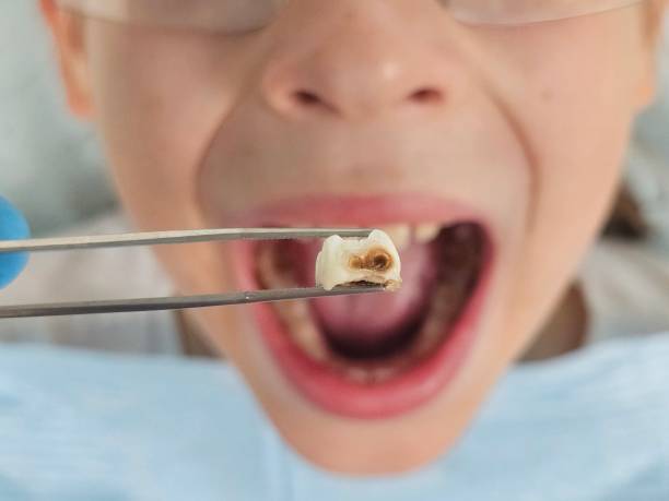 Best Chipped Tooth Repair Near Me  in Pass Christian, MS